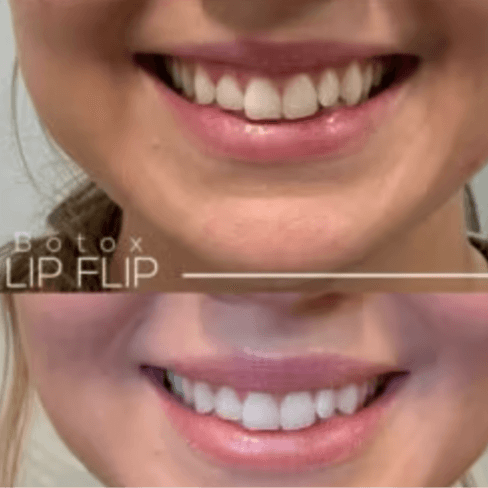 Lip Flip Membership at Knight Aesthetics in Lawton, OK