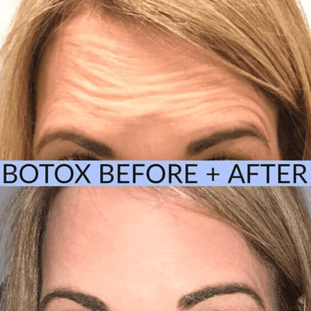 Botox Membership at Knight Aesthetics in Lawton, OK